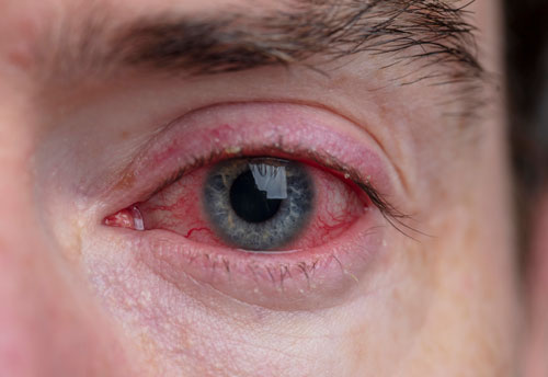“Is Corneal Swelling after Cataract Surgery normal ?”