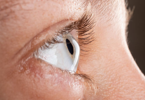 What is Keratoconus: Diagnosis and Treatment