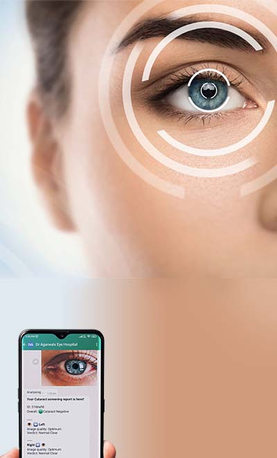Cataract