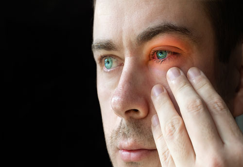 Here’s Your Guide to Blepharitis Treatment and Management