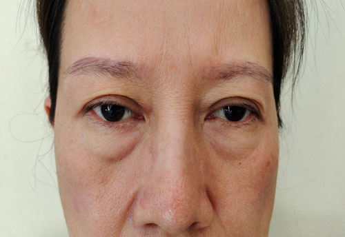 Ptosis கண்களுக்கு தீங்கு விளைவிப்பதா? Ptosis காரணங்கள் மற்றும் சிகிச்சை பற்றி அறியவும்