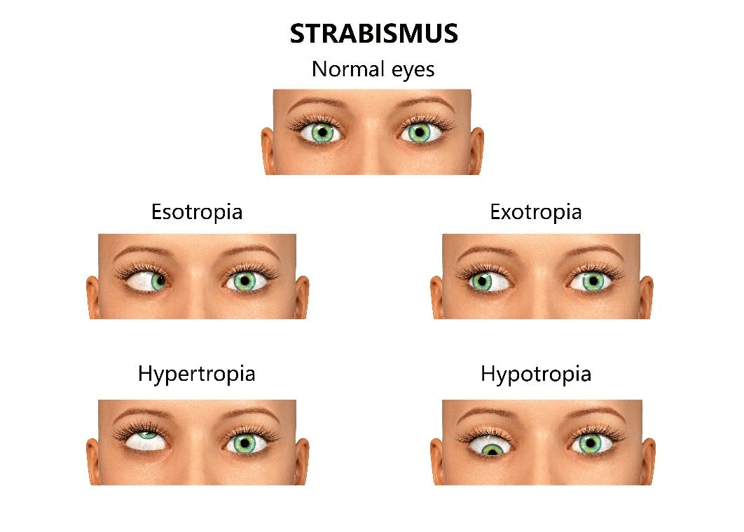 Strabismus