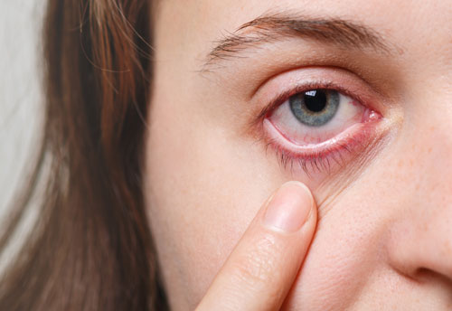 Conjunctivitis Eye Drops: ઉપયોગો અને આડ અસરો