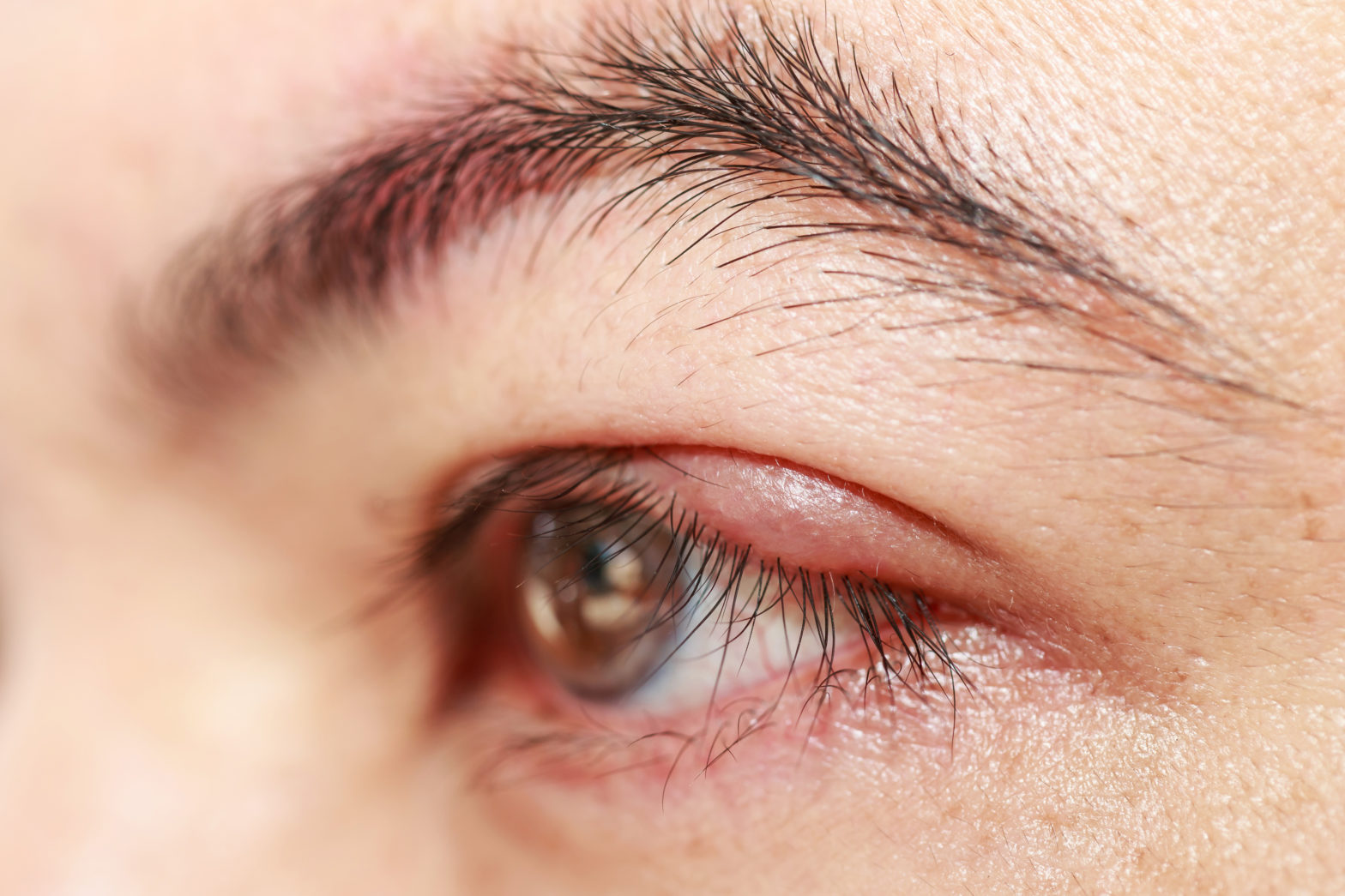 Understanding and Treating Blepharitis: An In-Depth Guide to Anterior Blepharitis and Posterior Blepharitis