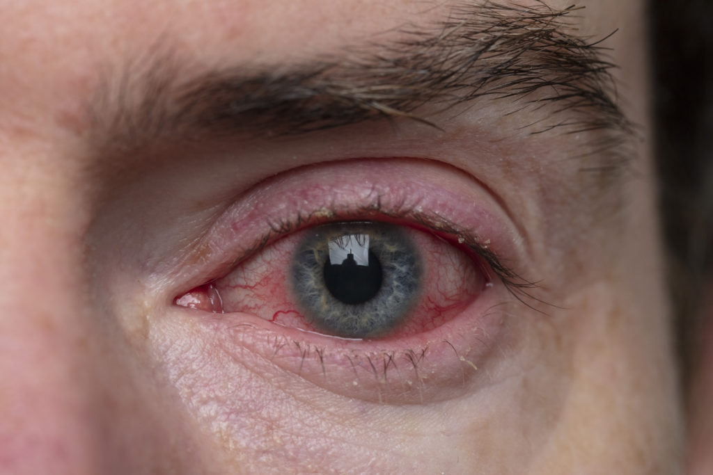 Corneal Eye Ulcer