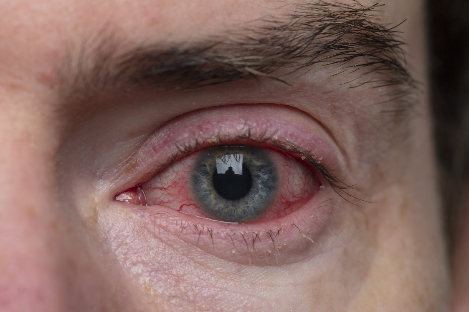 Corneal Eye Ulcer: Symptoms, Causes, Treatment, and Prevention Tips