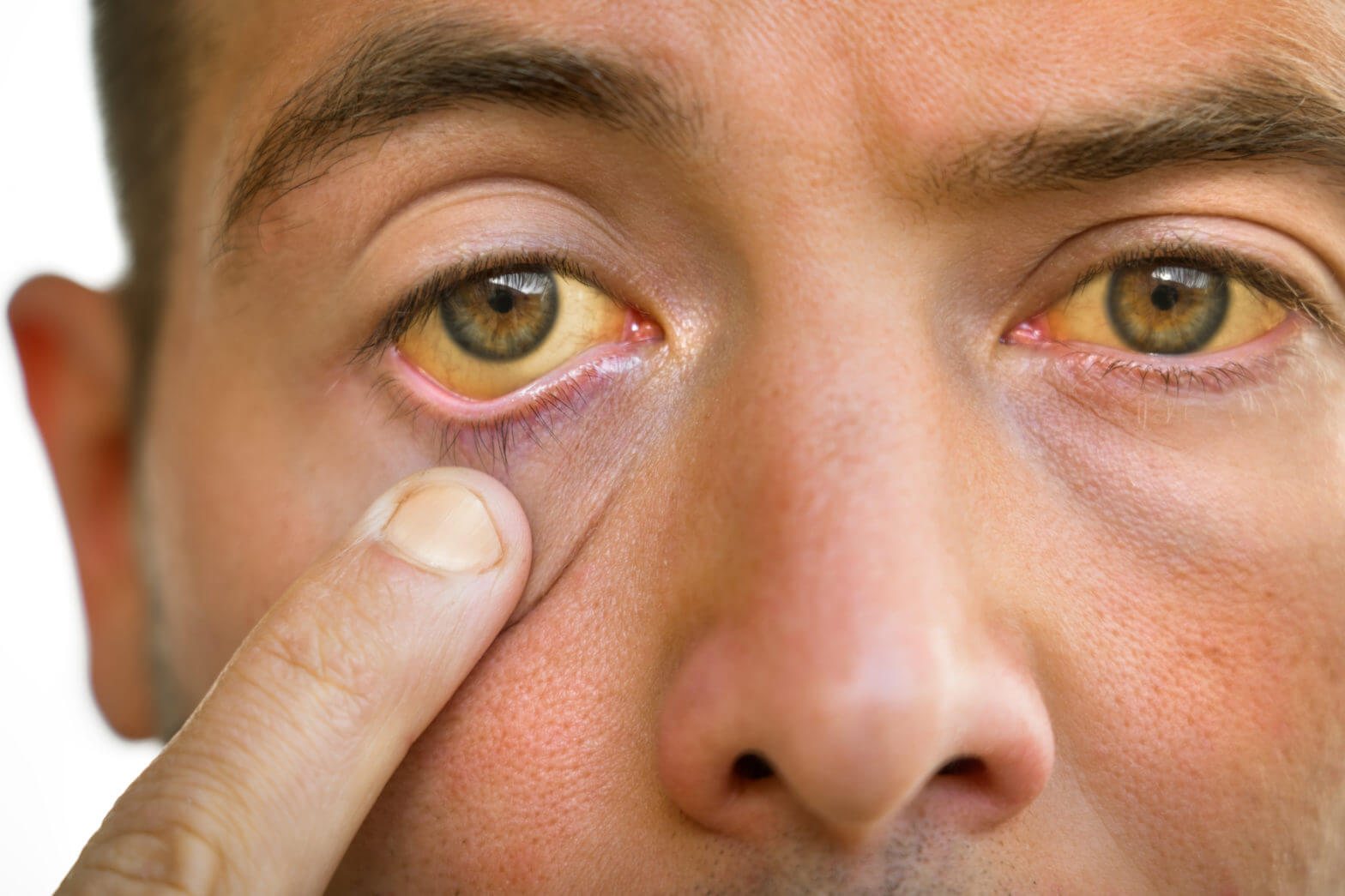 Are Glaucoma and Trachoma the Same?