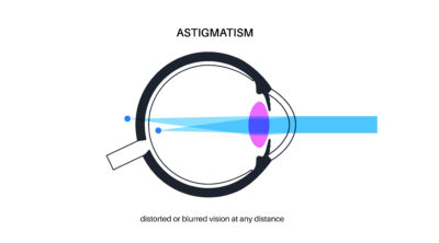Cylindrical Power or astigmatism