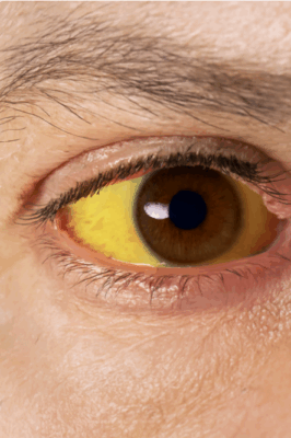 Scleral Icterus