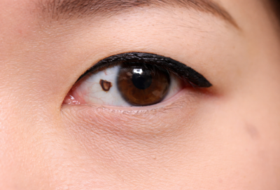 Brown Spot on Eye