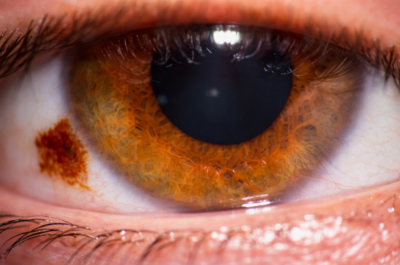 Brown Spot on Eye