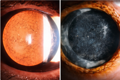 Posterior Capsular Opacification