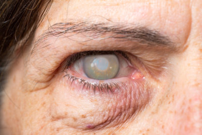 is glaucoma hereditary