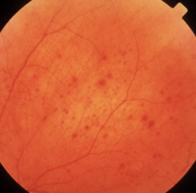 Retinal Hemorrhage