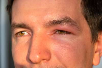 Swollen Eyelid Treatment